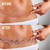 TuckTats: Sayura Cherry Blossom Temporary Tattoo - Tummy Tuck or Mastectomy Scar Cover, Realistic and Long Lasting, Fashionable and Safe view 3