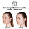Acne Treatment Pads- Eliminates Cystic Breakouts, Oily Skin & Clogged Pores. Clear Pimple, Whitehead, Blackhead, Dark Spots & Improve Skin Texture. view 3