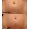 Provamed Stretch Mark Cream 7.04 Oz view 2