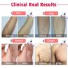 Permanent Hair Removal for Women & Men, IMENE 500,000 Flashes IPL Permanent Hair Removal & Upgrade Ice Compress - Home Use Hair Remover on Bikini line, Legs, Arms, Armpits - More Safe and Comfortable view 3