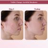 ACNE CLEANSER (4oz) Blemish Astringent Skin Care Oily Clogged Pores Blackheads Pimples Face Cleaner view 4
