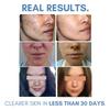 Clearogen Sensitive Skin Sulfur Acne Lotion, Acne Treatment, Sulfur Cream, Sulfur Ointment, Sulfur Spot Treatment, Sulfur Acne Treatment Cream 1.8 FL Oz view 3