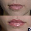 KD High Volume Lip Plumping Amplifier view 2