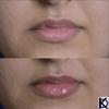 KD High Volume Lip Plumping Amplifier view 3