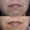 KD High Volume Lip Plumping Amplifier view 4